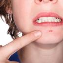 Léčba acne vulgaris (akné) - lokální i systémovou terapií