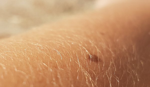 dermatitida, zdraví, kůže, péče o kůži, dermatitida