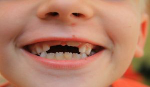 děti, zuby, zubní vyšetření dětí, péče o chrup dítěte