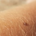 Druhy dermatitidy, příčiny, průběh a léčba