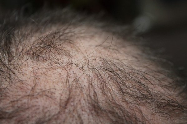 Zatočte z alopecií neboli ztrátou vlasů
